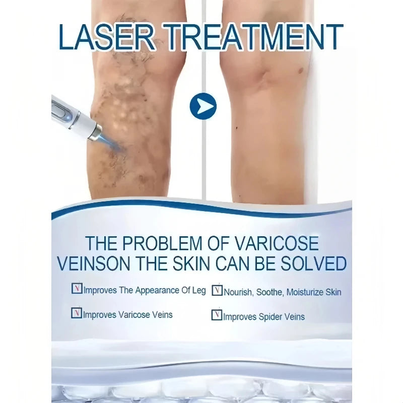 Blue Light Laser Vein Therapy | At-Home Treatment for Spider Veins & Swelling | Safe for Couperose Skin