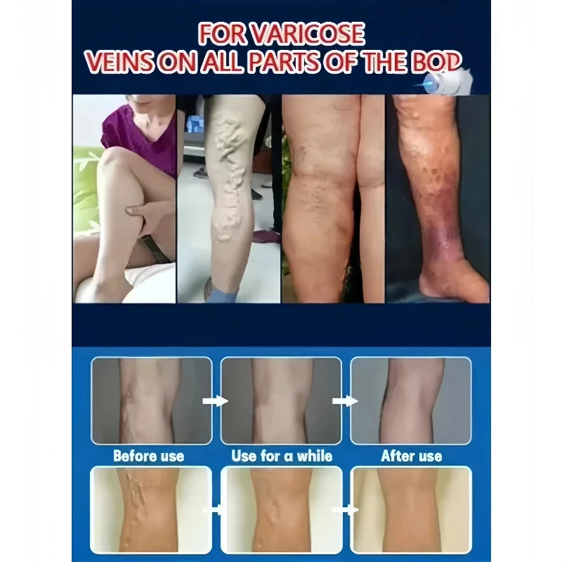 Blue Light Laser Vein Therapy | At-Home Treatment for Spider Veins & Swelling | Safe for Couperose Skin